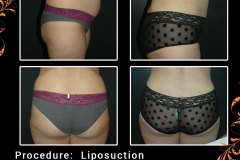 lipo-2432