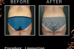lipo-2841
