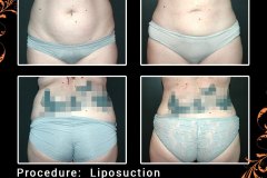 lipo-5723-c