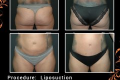 lipo-6164