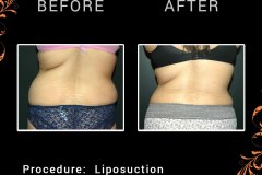 lipo-6219-c