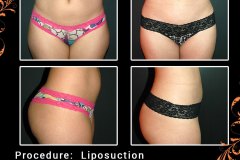 lipo-6293b