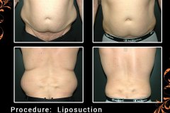 lipo-6316a