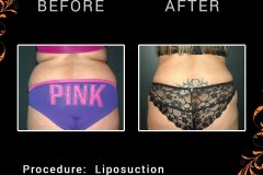 lipo-6329-c