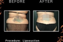 lipo-6523-c