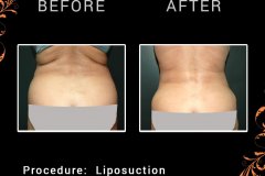 lipo-6524c