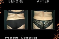 lipo-6531-c