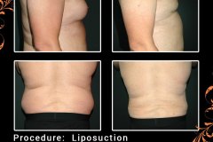 lipo-6691-c