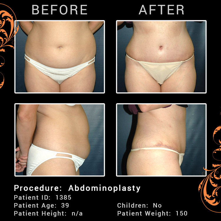 Tummy Tuck Before After Photos: Tummy Tuck Photo Gallery