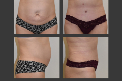 11_abdominoplasty