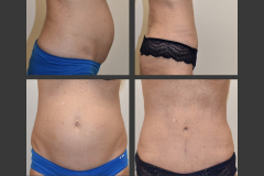 14_abdominoplasty