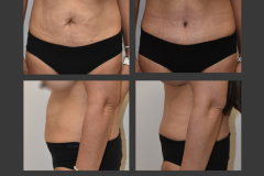 17_abdominoplasty