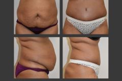 20_abdominoplasty