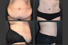 21_abdominoplasty