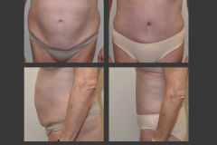 22_abdominoplasty