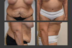 23_abdominoplasty