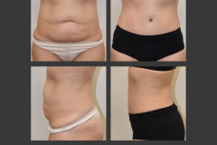 24_abdominoplasty