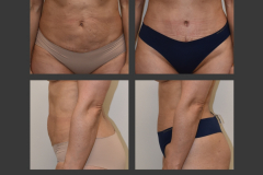 25_abdominoplasty