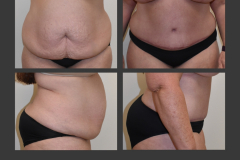 26_abdominoplasty
