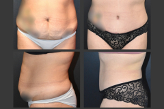 27_abdominoplasty