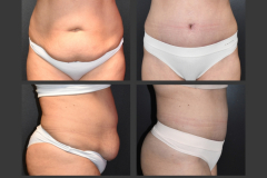 28_abdominoplasty