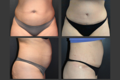 39_abdominoplasty