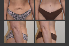 3_abdominoplasty