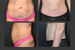44_abdominoplasty