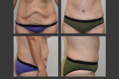 4_abdominoplasty