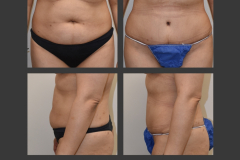 5_abdominoplasty