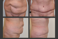 7_abdominoplasty