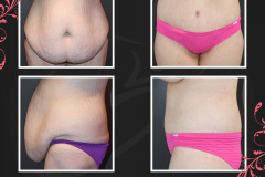 MAZ_BeforeAfter_Abdominoplasty_7598