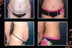 abdominoplasty-0010
