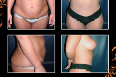 abdominoplasty-0019