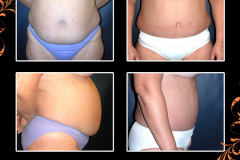 abdominoplasty-0154