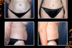 abdominoplasty-0171