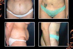 abdominoplasty-0272