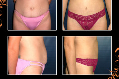 abdominoplasty-0275