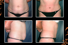 abdominoplasty-0287