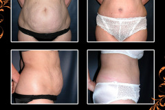 abdominoplasty-0297