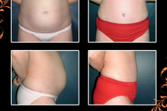abdominoplasty-0311