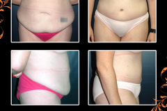 abdominoplasty-0323