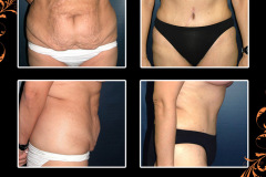 abdominoplasty-0329