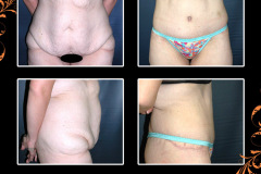 abdominoplasty-0332
