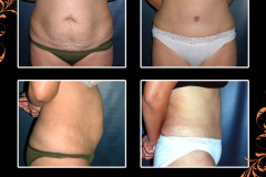 abdominoplasty-0366