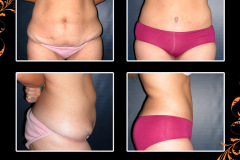 abdominoplasty-0370