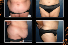 abdominoplasty-0384