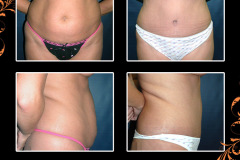 abdominoplasty-0401