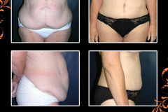abdominoplasty-0405