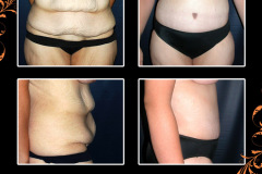 abdominoplasty-0453